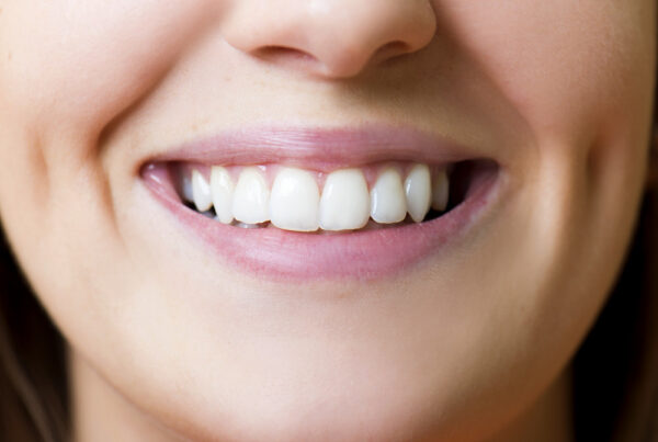 porcelain veneer