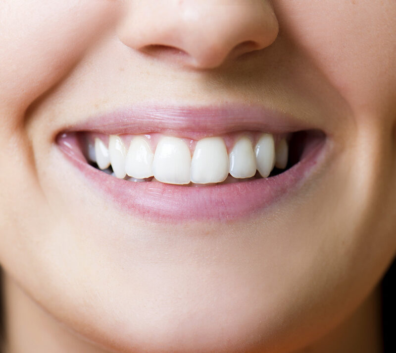 porcelain veneer