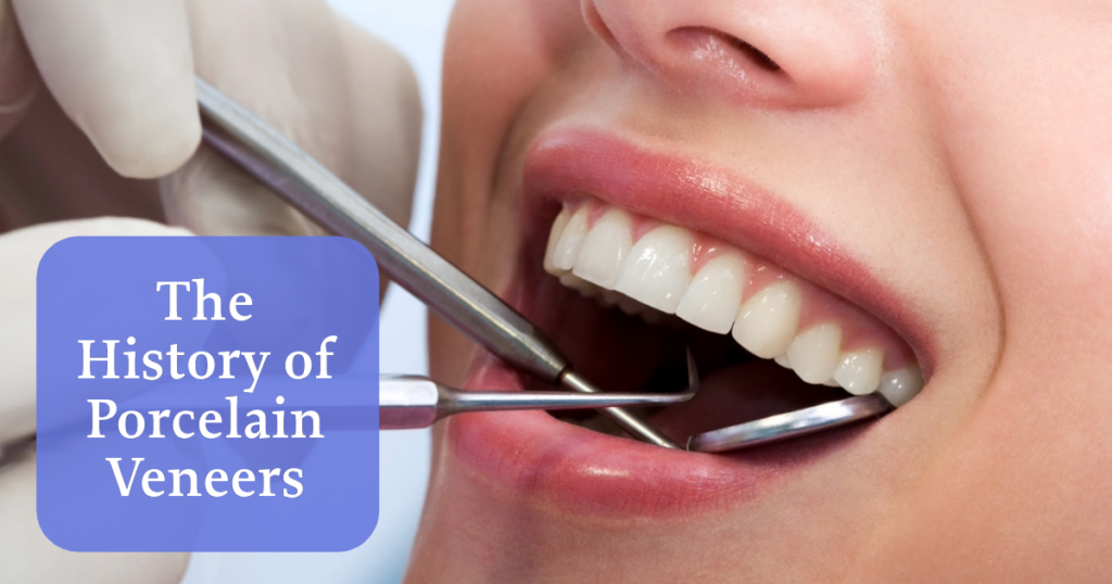 veneers