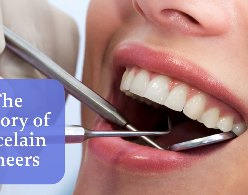 veneers