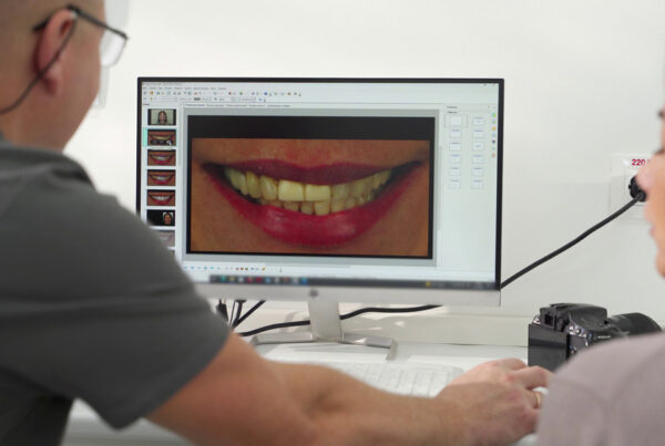 veneers