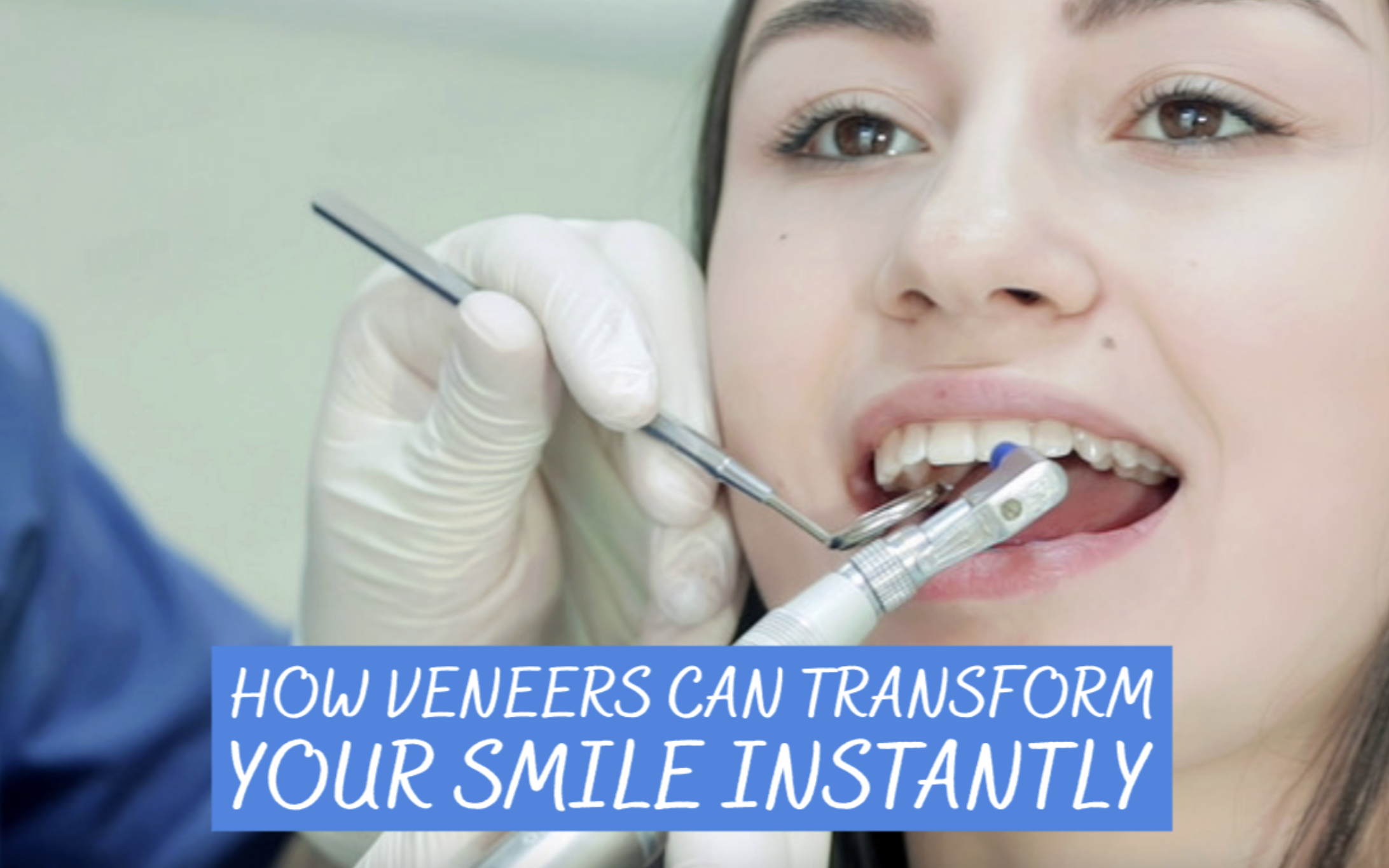 veneers