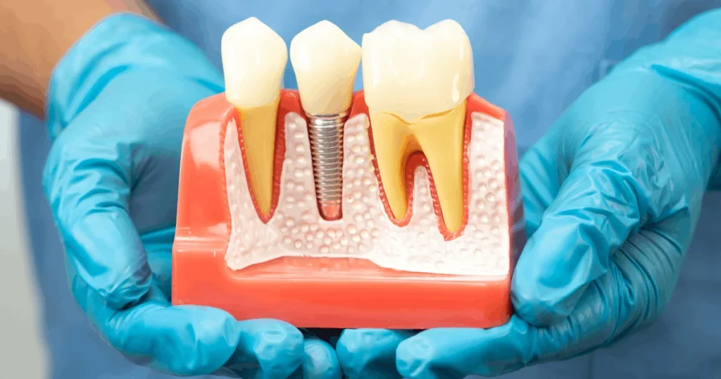 Dental Implants in Encino A Patient-Friendly Guide to Replacing Missing Teeth