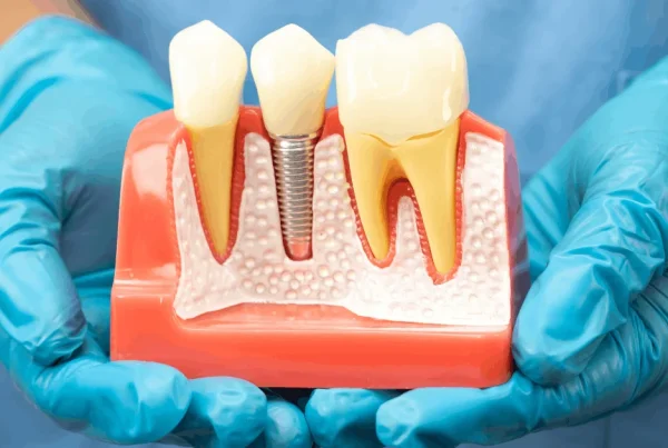 Dental Implants in Encino A Patient-Friendly Guide to Replacing Missing Teeth