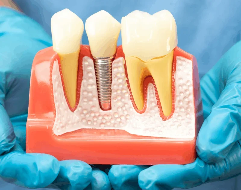 Dental Implants in Encino A Patient-Friendly Guide to Replacing Missing Teeth