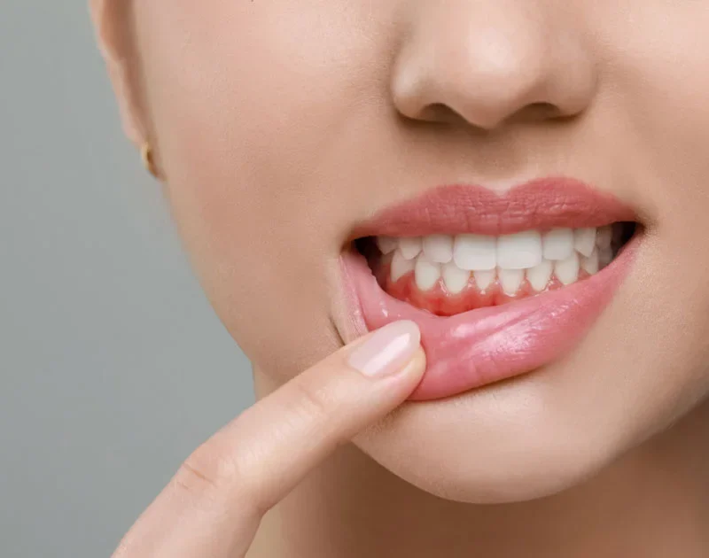Gum Disease Signs You Should Not Ignore