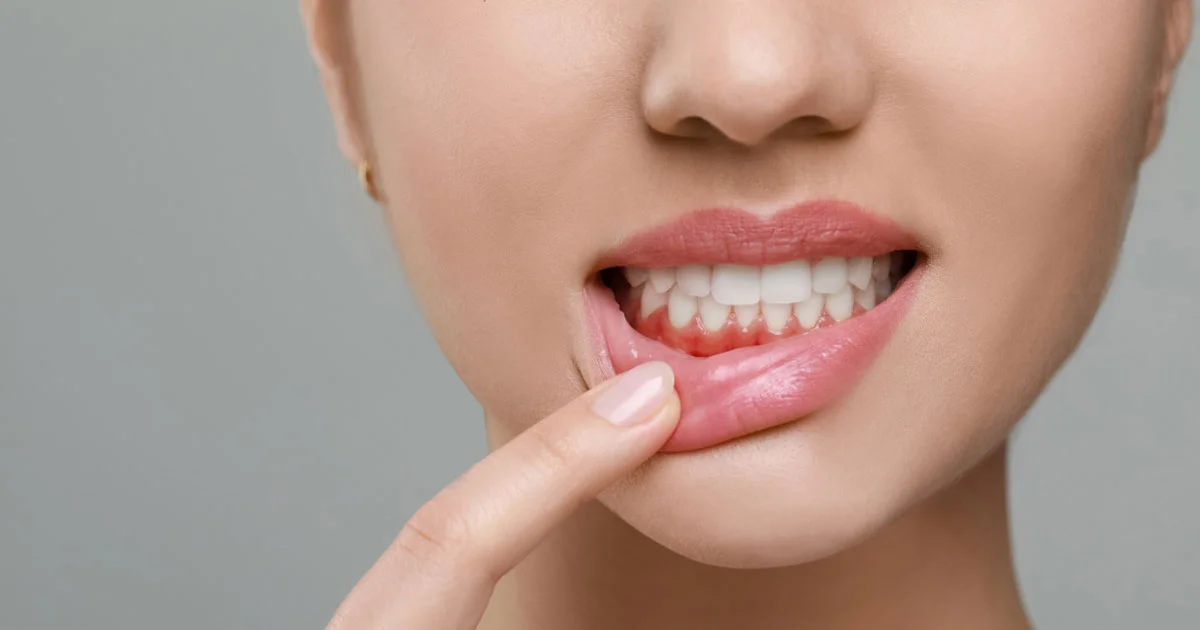 Gum Disease Signs You Should Not Ignore